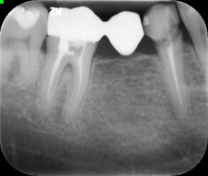 Allongement de couronne - Les dentistes spécialistes de Châteauguay